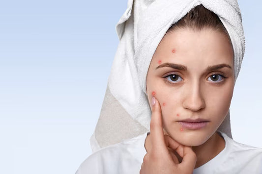 What Causes Face Pimples & How To Deal With Them?