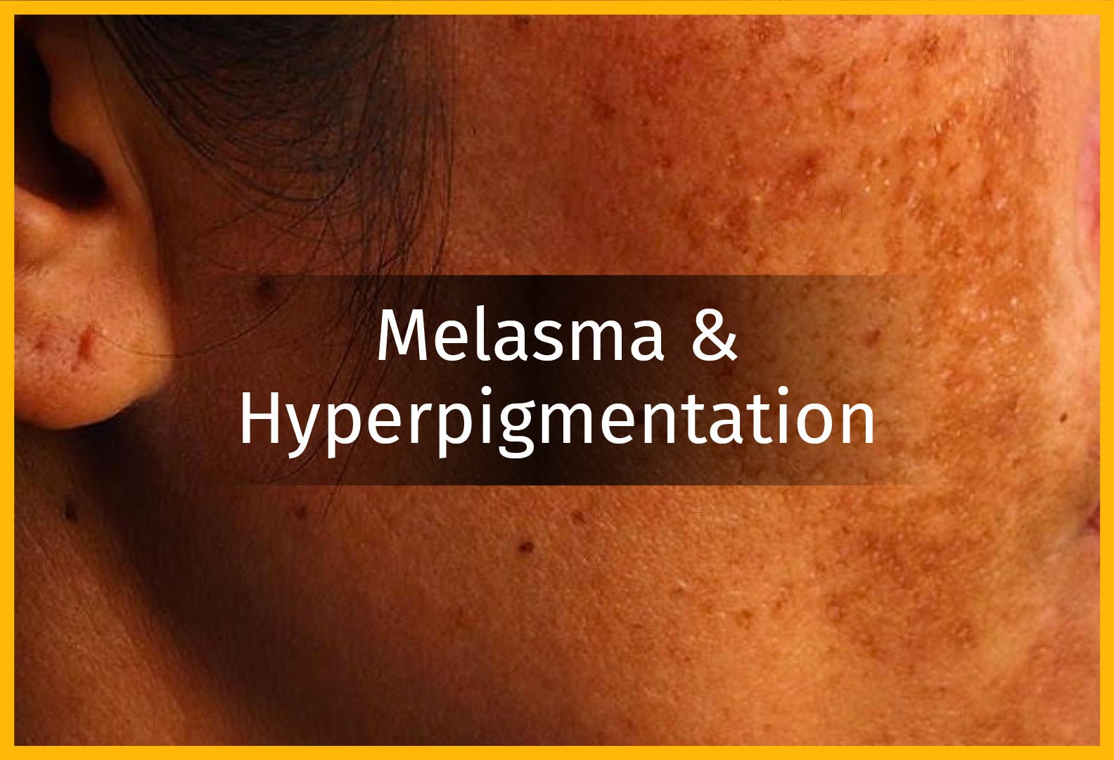 Hyperpigmentation and Melasma: Are they the same or different?
