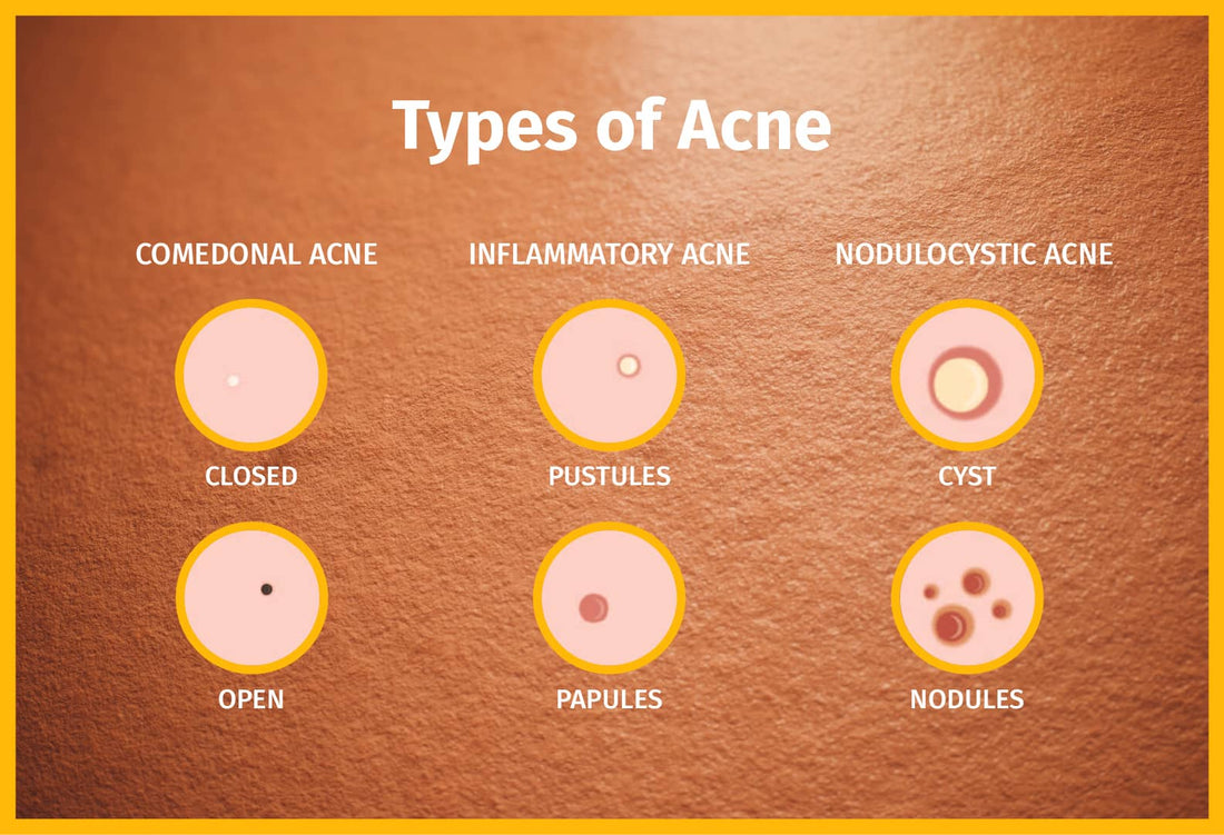 Know About Acne myths - Types & Treatment Guide | SkinQ