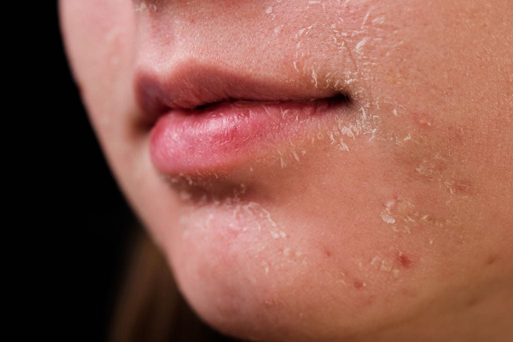 The Ultimate Guide to Treating Dry Skin on the Face: Causes, Symptoms, and Remedies
