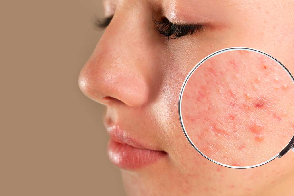 Is my acne 'Fungal Acne'?