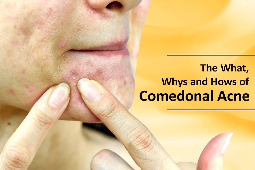 What Is Comedonal Acne & Ways To Treat It
