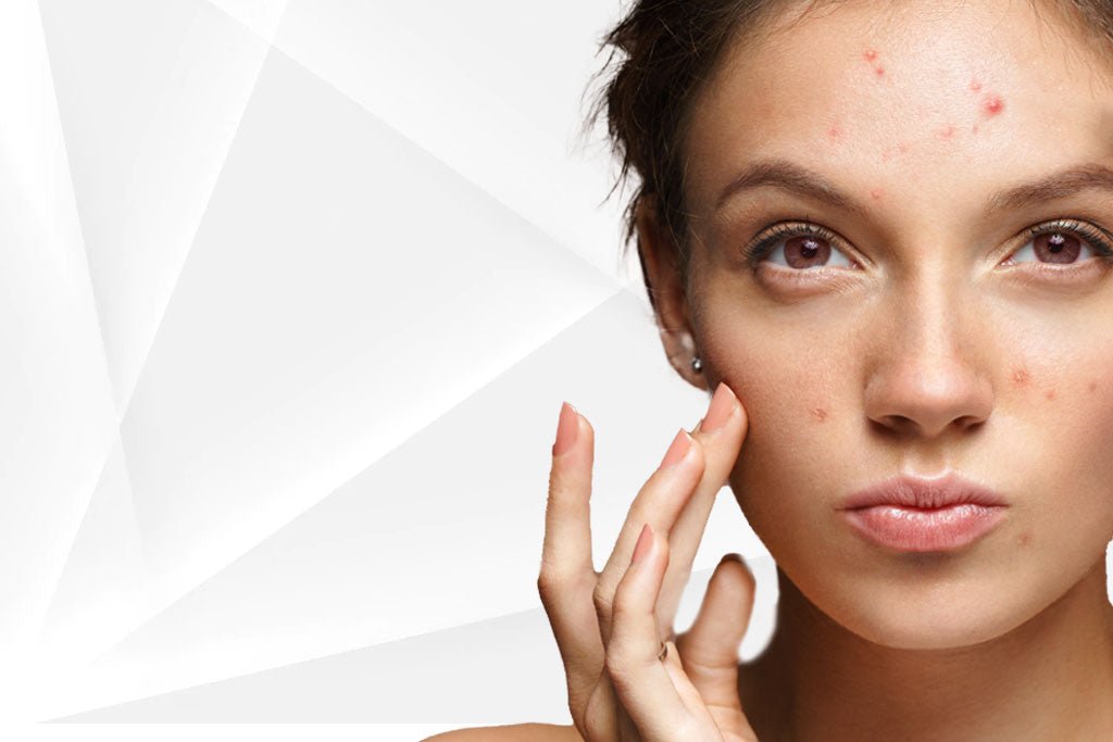 Treating Teenage Acne: A Complete Guide