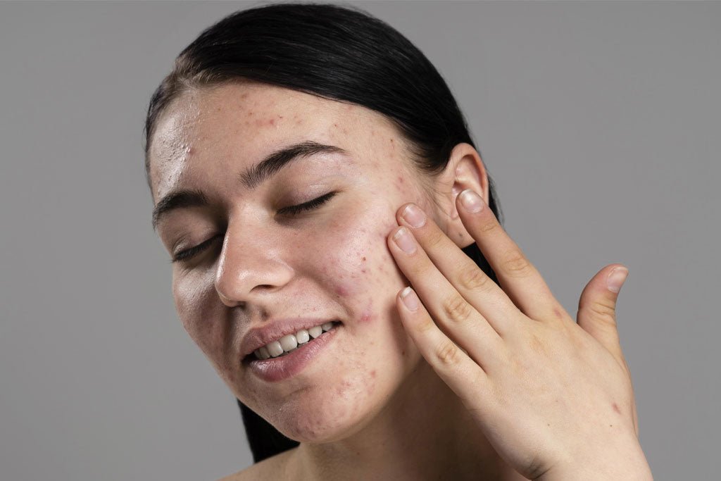 Understanding Acne: A Comprehensive Guide to Different Types of Pimples and Their Causes, Symptoms, and Treatments