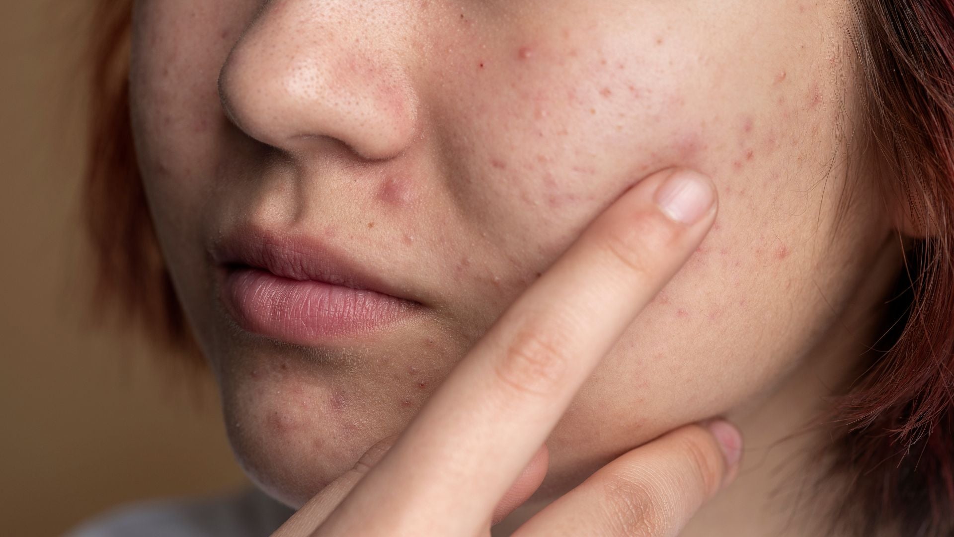 Acne in Your 20s and 30s: What You Need to Know – SkinQ