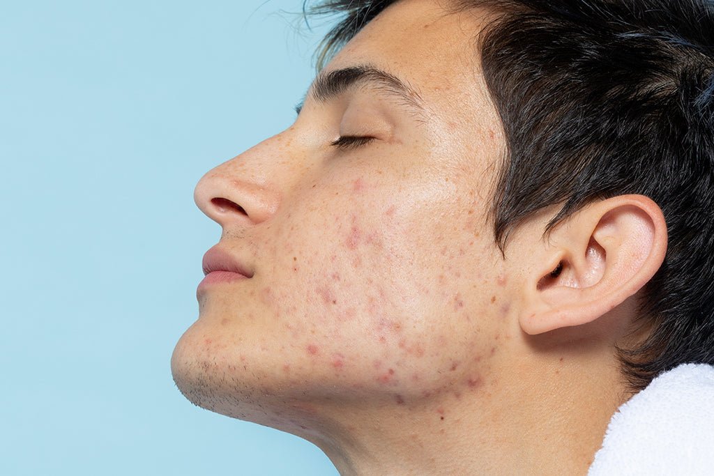 10 Surprising Causes of Adult Acne (and How to Get Rid of It)