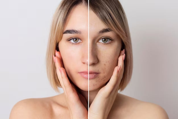 How to Remove Pigmentation from the Face Permanently?