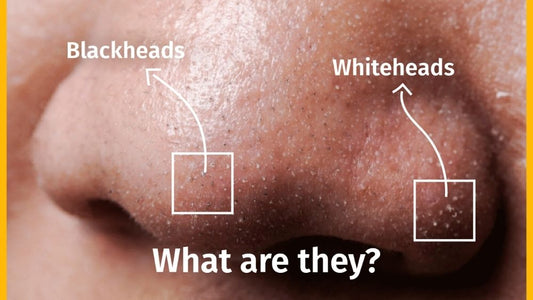 Know about Whiteheads and Blackheads | Ultimate guide to reduce them | SkinQ
