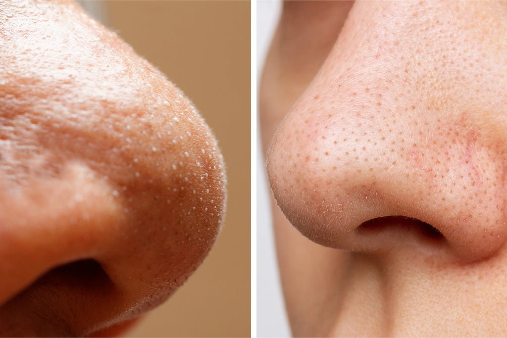 Difference Between Whiteheads and Blackheads for Clearer Skin