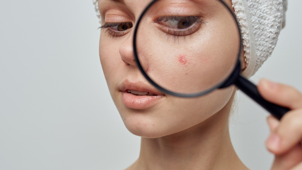 Is Acne your biggest foe?