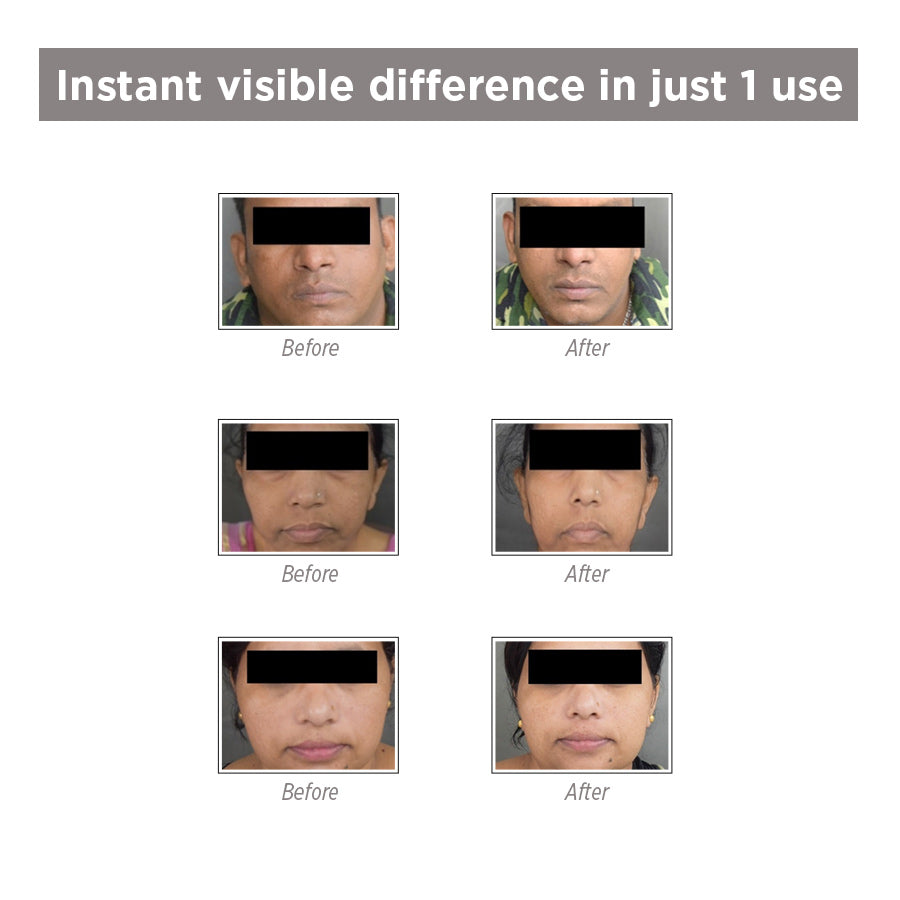 Detan+Glow Active Facial Kit - Anti Tan & Anti Pigmentation Facial Kit - SkinQ