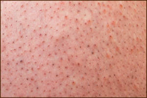 Strawberry skin concern in melanin skin