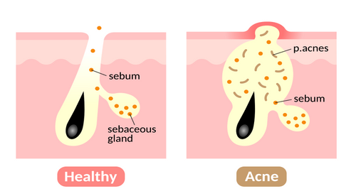 Acne Issues with Melanin skin