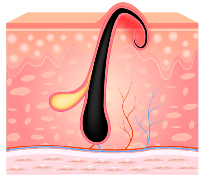 Ingrown hair growth in Melanin skin