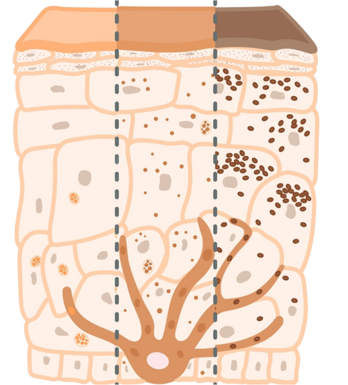 Hyperpigmentation in Melanin skin